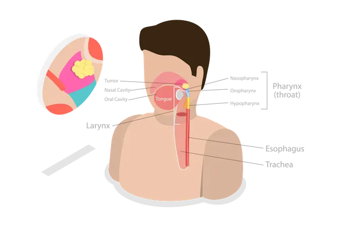 Nasopharyngeal Carcinoma Tumor  Illustration